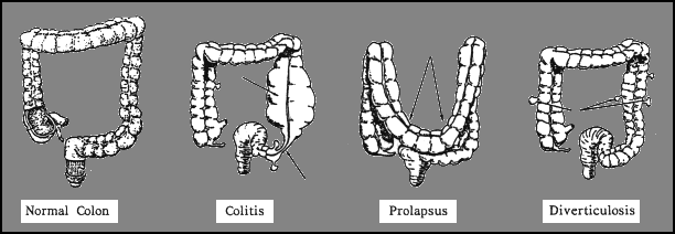 Avoid colitis, diverticulitis, diverticulosis, cancer of the colon, and digestive problems. Keep the colon clean and healthy.